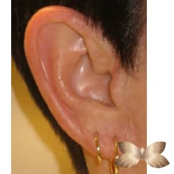 Earlobe Reduction by Dr. Thompson