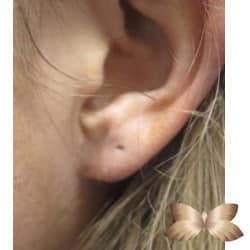 Earlobe Repair by Dr. Henstrom