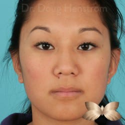 Otoplasty by Dr. Henstrom