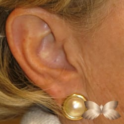 Earlobe Repair by Dr. Thompson