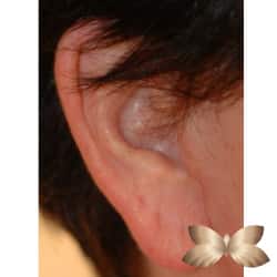 Earlobe Reduction by Dr. Thompson