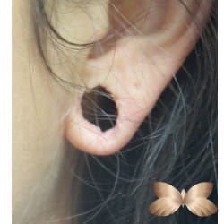 Earlobe Repair by Dr. Henstrom