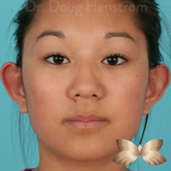 Otoplasty by Dr. Henstrom