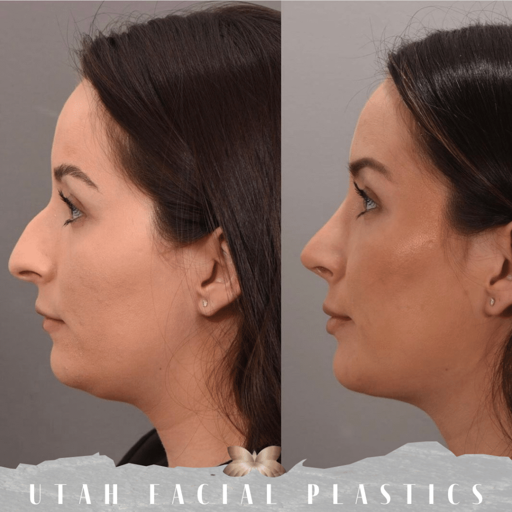Deep Neck Contouring Before and After