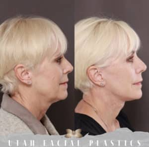 Facelift by Dr. Douglas Hnestrom