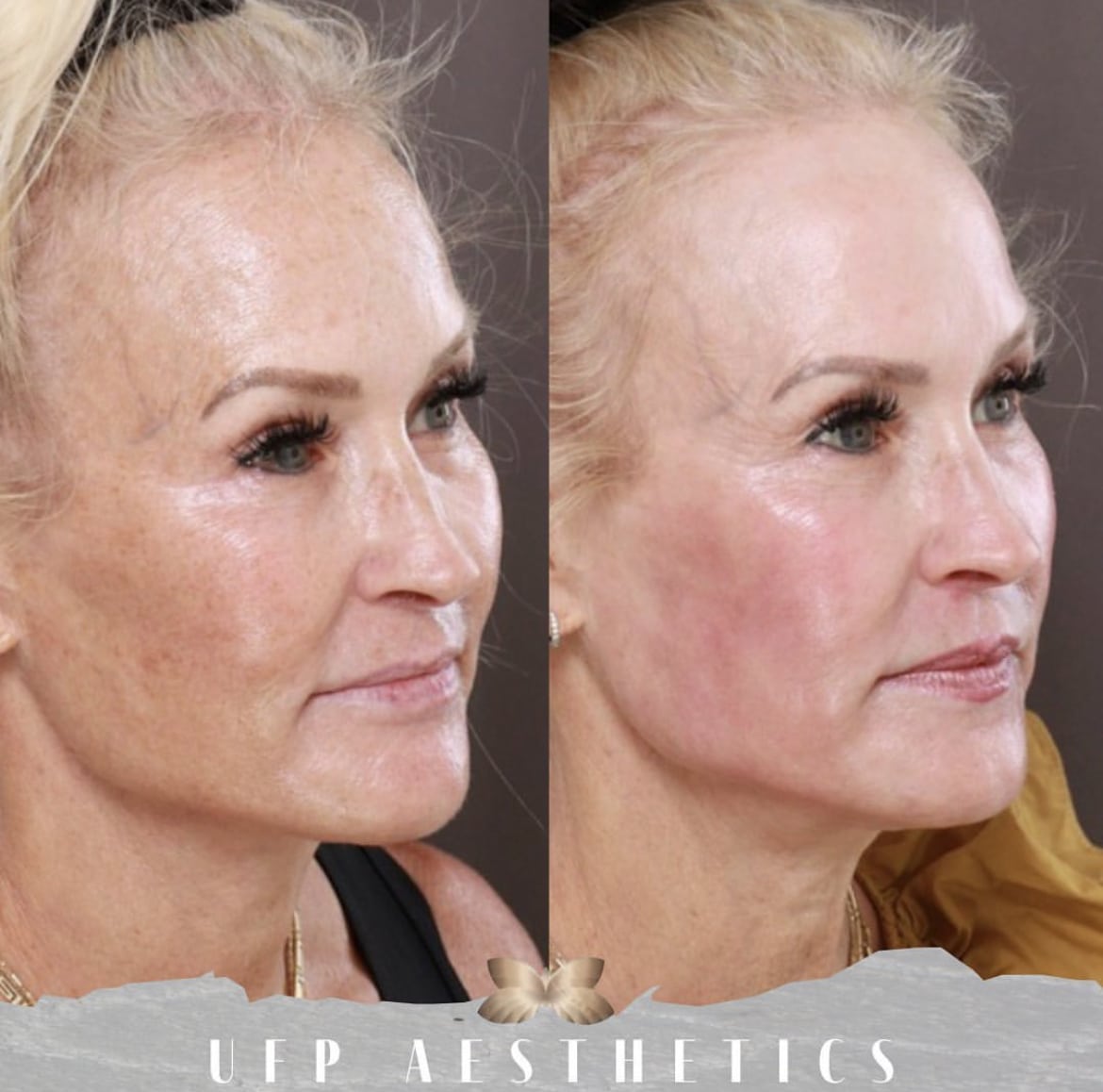 A Natural Facelift That Won't Make You Look Fake Utah Facial Plastics