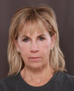 Facelift & Browlift by Dr. Thompson