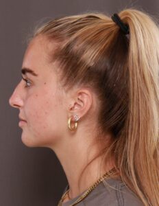 Rhinoplasty by Dr. Manning