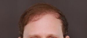 FUE Hair Transplant by Dr. Henstrom