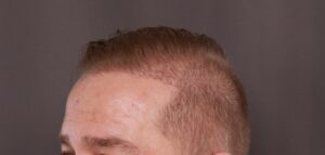 FUE Hair Transplant by Dr. Thompson