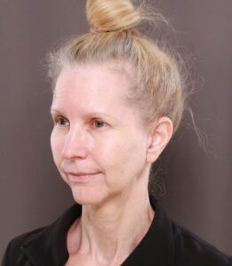 Macslift, Chin Implant, & Upper Blepharoplasty by Dr. Thompson