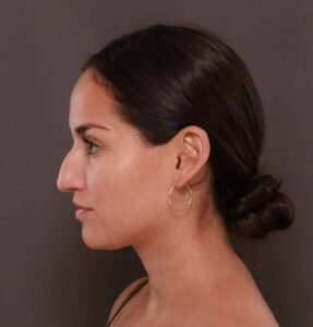 Rhinoplasty by Dr. Henstrom
