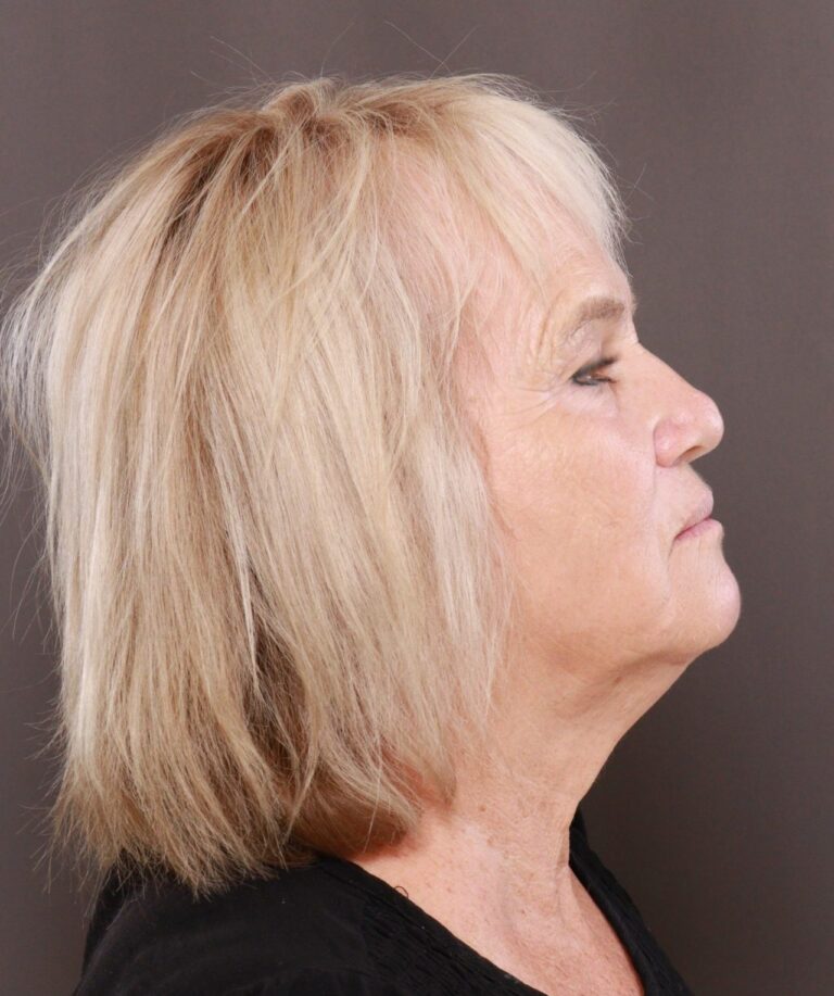 After Image: Contour TRL & BBL by Katy Larson - right-side