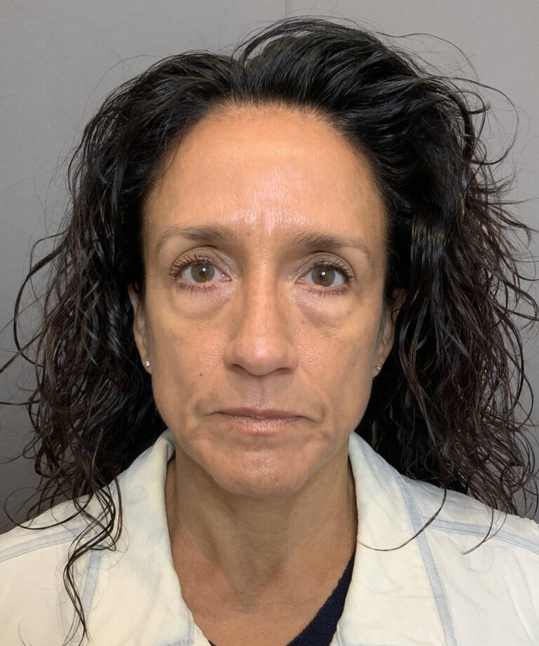 Before Image: Lower Blepharoplasty with Periorbital Fat Transfer by Dr. Henstrom - front
