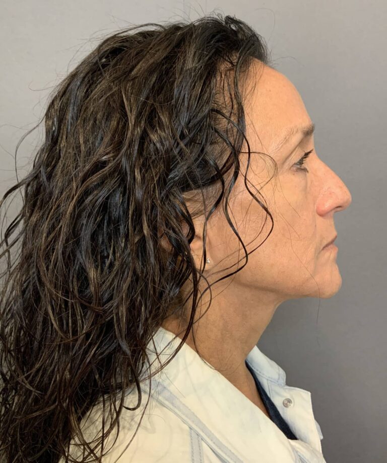 Before Image: Lower Blepharoplasty with Periorbital Fat Transfer by Dr. Henstrom - right-side