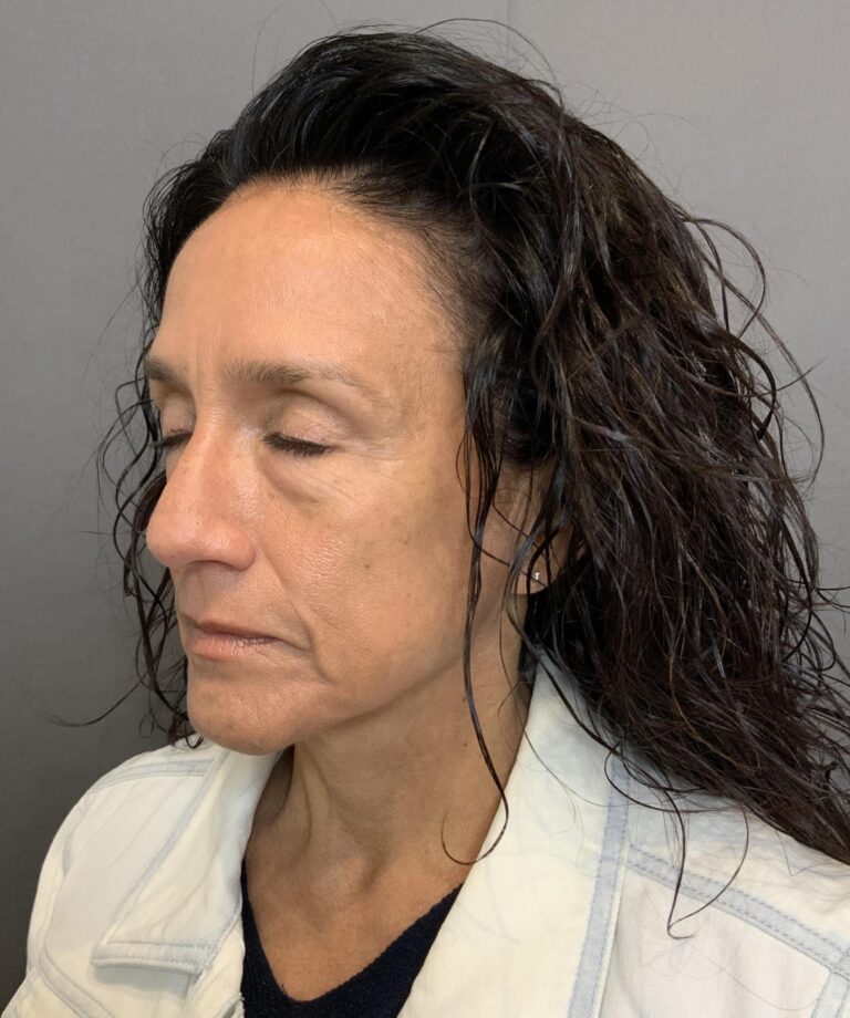 Before Image: Lower Blepharoplasty with Periorbital Fat Transfer by Dr. Henstrom - left-front-oblique