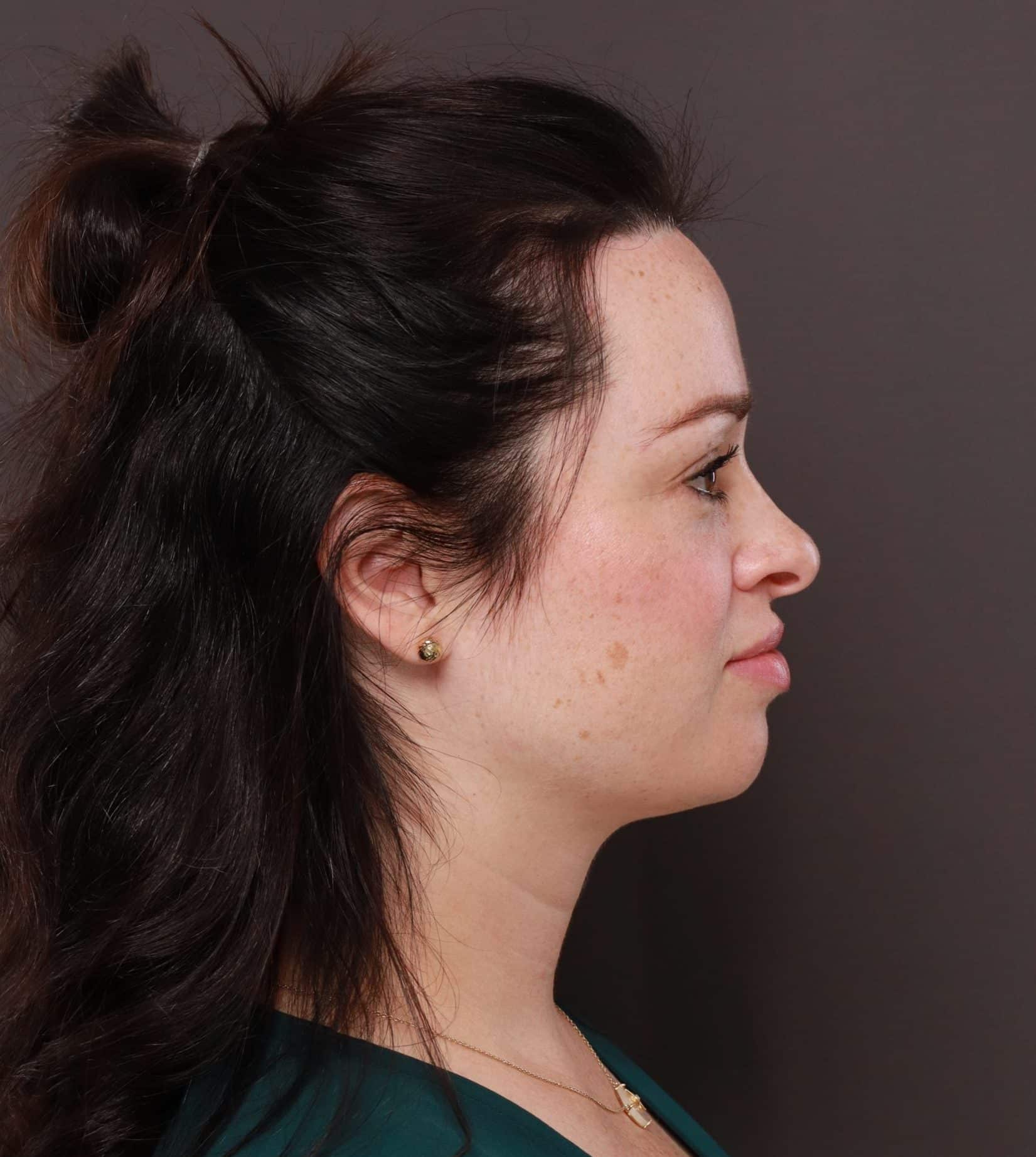 Forehead Reduction by Dr. Thompson Utah Facial Plastics