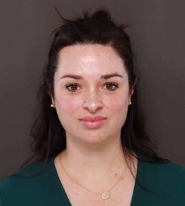 After Image: Forehead Reduction by Dr. Thompson