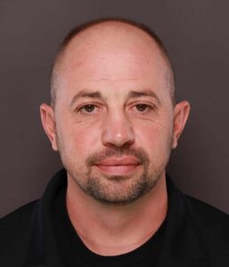FUE Hair Transplant by Dr. Thompson