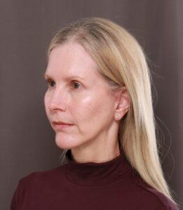 Macslift, Chin Implant, & Upper Blepharoplasty by Dr. Thompson