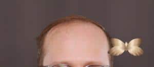 FUE Hair Transplant by Dr. Henstrom