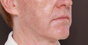 Halo & BBL Laser Resurfacing by Katy Larson