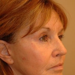 After Image: Surgical Procedures Patient 52818 - right-front-oblique