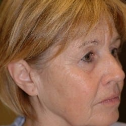 Before Image: Surgical Procedures Patient 52818 - right-front-oblique