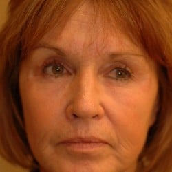 After Image: Surgical Procedures Patient 52818 - right-front-oblique