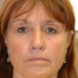 Before Image: Surgical Procedures Patient 52818 - right-front-oblique