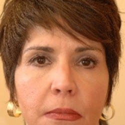 After Image: Surgical Procedures Patient 36027 - left-front-oblique