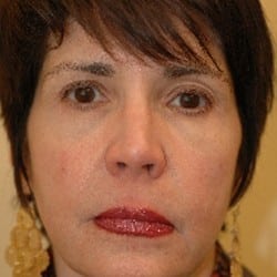 Before Image: Surgical Procedures Patient 36027 - left-front-oblique