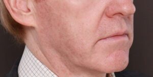 Halo & BBL Laser Resurfacing by Katy Larson