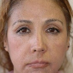 Before Image: Mid-Facelift Patient 78183 - right-front-oblique