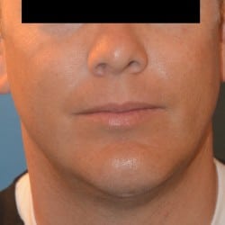 Chin Implant and Submental Liposuction by Dr. Thompson