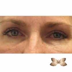 Upper Eyelid Surgery By Dr. Henstrom