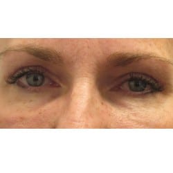 After Image: Upper Eyelid Surgery By Dr. Henstrom - front