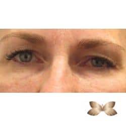 Upper Eyelid Surgery By Dr. Henstrom