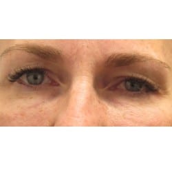 Before Image: Upper Eyelid Surgery By Dr. Henstrom - front