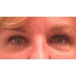 After Image: Upper Eyelid Surgery by Dr. Thompson