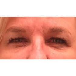 Before Image: Upper Eyelid Surgery by Dr. Thompson