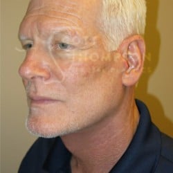 After Image: Facelift Before and After Photos | Utah Facial Plastics 405 -