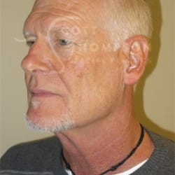 Before Image: Facelift Before and After Photos | Utah Facial Plastics 405 -