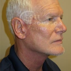 After Image: Facelift Before and After Photos | Utah Facial Plastics 405 - right-front-oblique