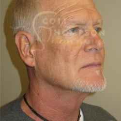 Before Image: Facelift Before and After Photos | Utah Facial Plastics 405 - right-front-oblique