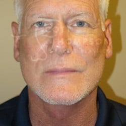 After Image: Facelift Before and After Photos | Utah Facial Plastics 405 -