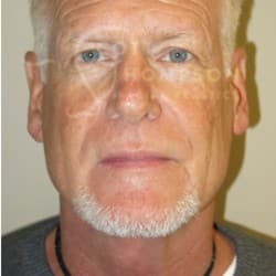 Before Image: Facelift Before and After Photos | Utah Facial Plastics 405 -