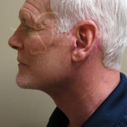 After Image: Facelift Before and After Photos | Utah Facial Plastics 405 - left-side