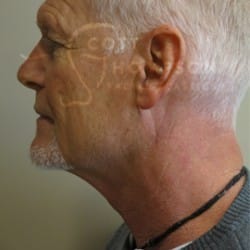 Before Image: Facelift Before and After Photos | Utah Facial Plastics 405 - left-side