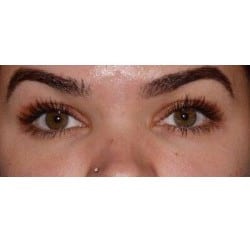 After Image: Upper Blepharoplasty and Under- Eye Filler  by Dr. Thompson